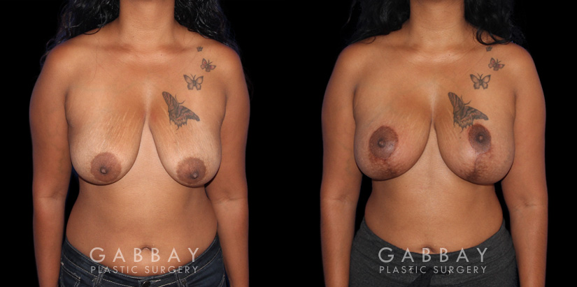 Wise Mastopexy with Silicone Breast Implants