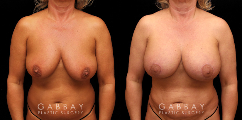Patient 23 Front View Breast Aug/Pexy with Liposcution and J-plasma to the Full Abdomen and Upper Back Bra Roll Gabbay Plastic Surgery