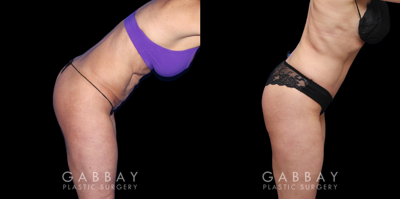 Before and after photos for body procedures, including a tummy tuck and inner thigh liposuction. Combining the procedures resulted in a flatter, smoother abdomen balanced with subtle yet effective tightening of the thighs. The final result evokes a more youthful contour.