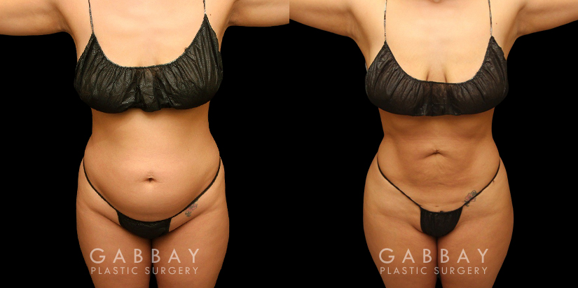 Female abdominal fat removal results showcasing a patient's flatter tummy area, with no side effects from the liposuction procedure. The fat removed is permanently gone, with straightforward maintenance of results.