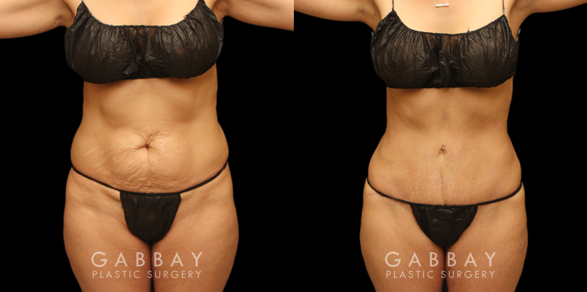 Tummy Tuck Revision and Repair by Beverly Hills Female Plastic