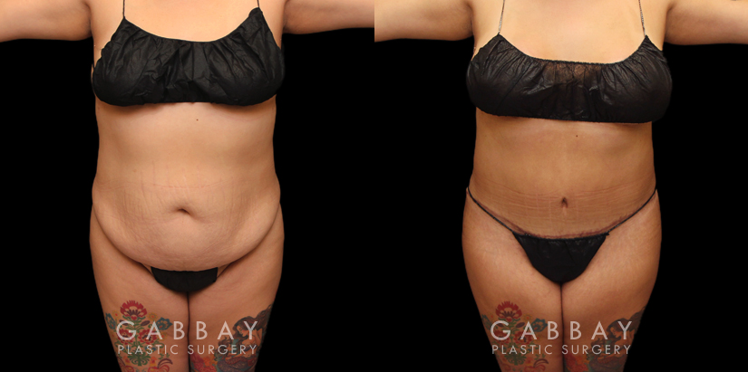 Tummy tuck before and after photos, along with combined liposuction, breast lift, and breast augmentation. Abdominal tightening enhanced the increase in breast volume for a curvier, fitter aesthetic.