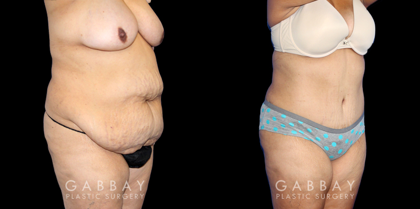 Patient results after liposuction to the back bra roll with significant abdominal tightening. Note the decrease in volume of abdominal fat and excess skin, with no visible scarring from any angle. Patient achieved a flat profile silhouette absent of any folds.