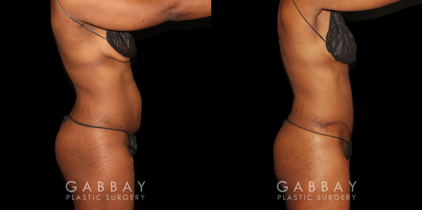 Patient following tummy tuck and hernia repair, showcasing results from multiple angles. Note the absence of stomach overhang in the leaning forward position, demonstrating effective tightening of multiple tissue layers.