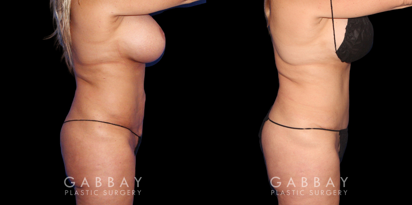 Female tummy tuck patient before and after precise abdominoplasty. Patient had minor, stubborn fat pockets removed and then the abdominal skin was tightened to restore a youthful firmness and texture.