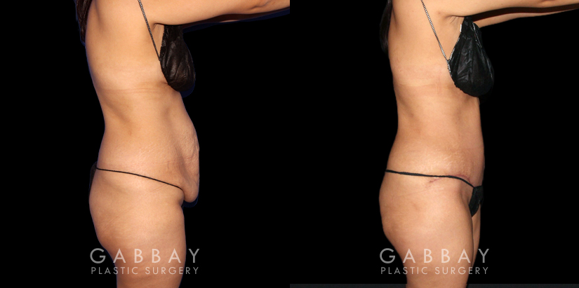 Multi-angle view of patient before and after tummy tuck combined with waist and arm liposuction. The combined approach allowed for results that balanced well with each other, creating a firmer body contour that maintained a natural look.