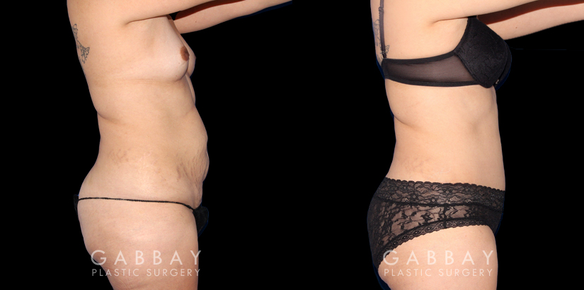 Patient 19 Right Side View Abdominoplasty Gabbay Plastic Surgery