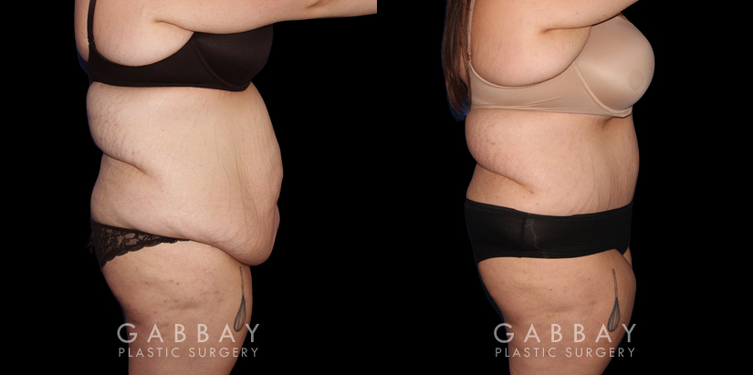 Abdominoplasty patient results, highlighting the loose skin and folds before the procedure. Following surgery, the patient recovered without complications and saw lasting tummy tuck results with a flatter profile.