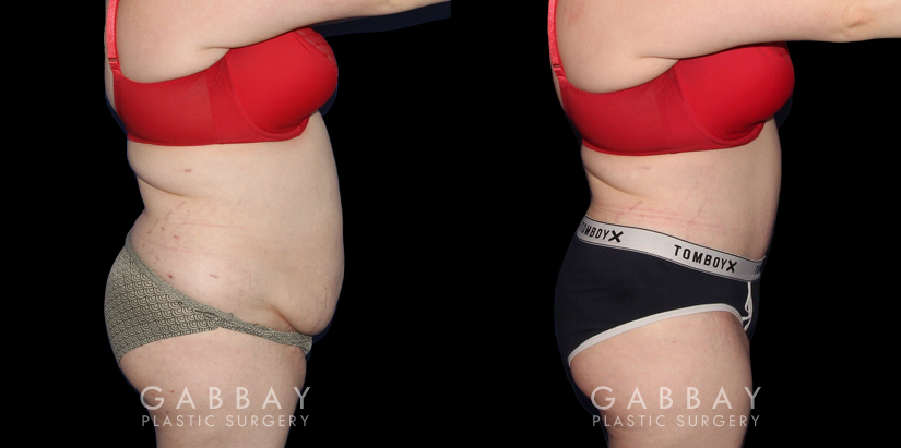 Patient before and after her tummy tuck procedure combined with liposuction around the waist. The final effect is slimming from multiple angles with no visible scarring. Note the smoother texture of skin and lending to a more youthful visual.