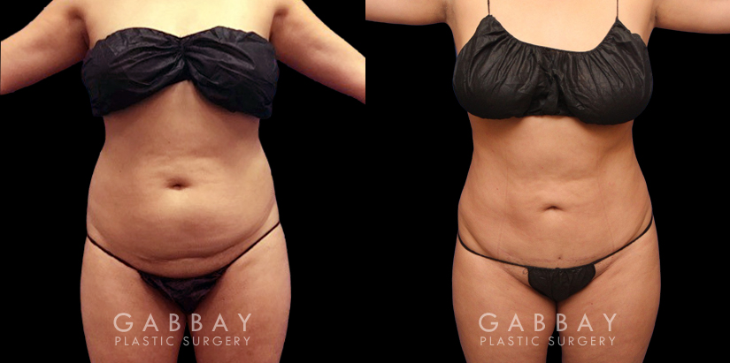 Results of a safe abdominal liposuction surgery that provided this female patient with notable slimming. Note the flat stomach from the profile view with no overhang above the waistline.