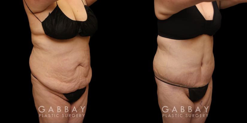 Patient before and after tummy tuck combined with breast lift. The tightening of the abdomen along with the repositioning of the breasts creates a more balanced aesthetic with tighter skin.