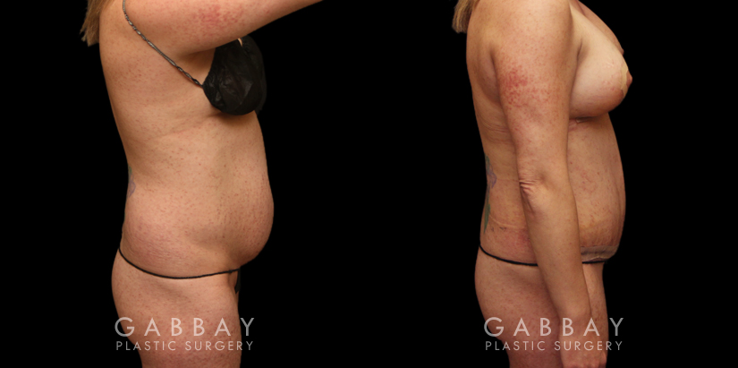 Patient 24 Right Side View Breast Aug/Pexy and Tummy Tuck Gabbay Plastic Surgery