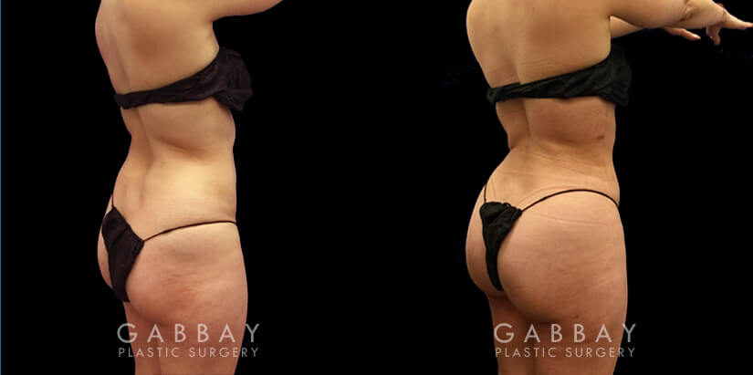 BBL surgery results for female patient after the fat injections fully settled. Note the significant increase in buttocks volume without the use of butt implants, resulting in a rounded, lifted shape that curves into the small of the back for an enhanced contour. Around the waist, back, and abdomen, 360 liposuction provided a smooth slimming effect that emphasizes the full roundness of the butt.