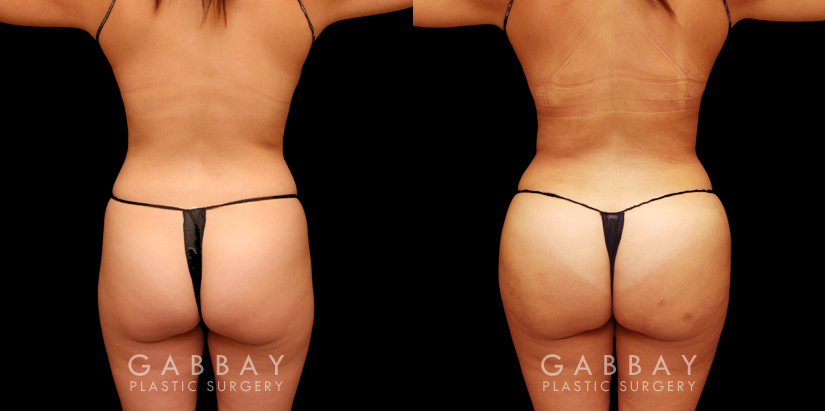 Back and side view of female patient results before and after liposuction to abdomen and waist with fat transfer to butt. Lipo results provided abdominal and waist contouring, slimming the figure while providing increased volume and shape to the buttocks. All volume increase is from injections with no artificial implants used. Note natural appearance and lack of visible scarring.