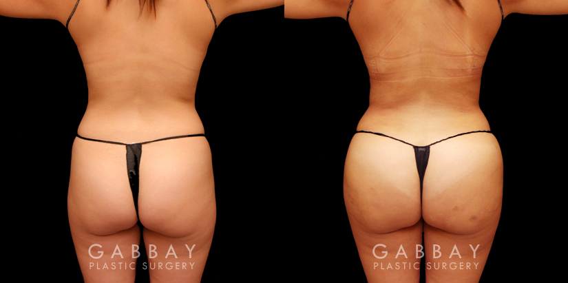 Brazilian Butt Lift  Lipoaesthetic Female