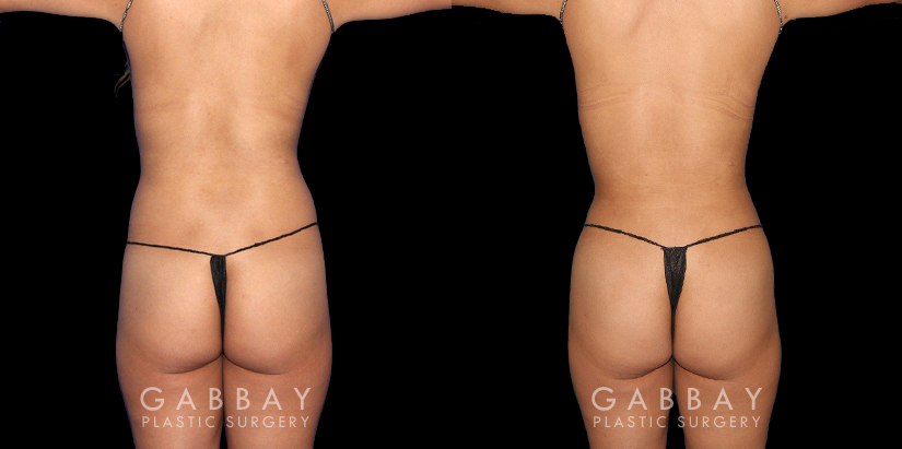 Multiple angle view of Caucasian patient in her mid-30s before and after mini Brazilian butt lift surgery and combined 360 liposuction for body contouring and butt augmentation. Liposuction provided improved abdominal contouring focusing on the abdomen, waist, and tailbone areas. The transferred fat settled well into round-shaped buttocks for a stable cosmetic enhancement as part of this skinny BBL.