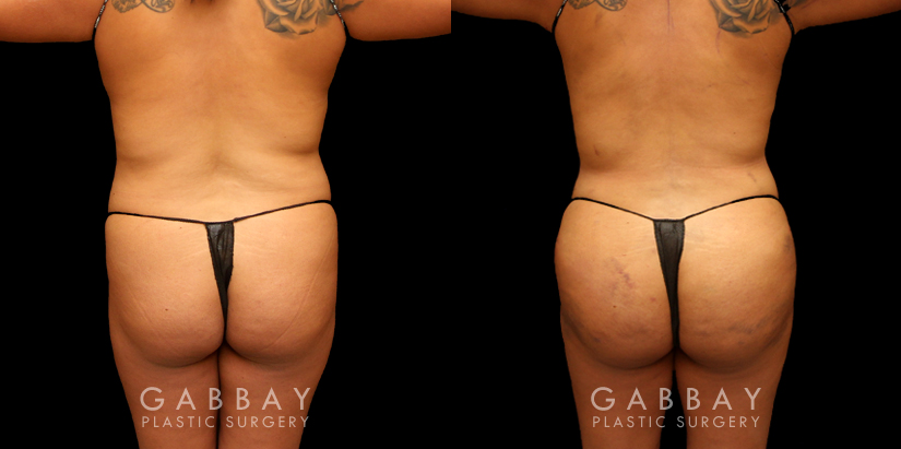 Back and partial angle view of a patient before and after butt lift surgery performed by a BBL specialist. Notice the lifted contour of the butt, enhancing the transition from upper hips to the rounded buttocks. Combined liposuction around the flanks provided a slimmer waist for a skinnier yet voluminous body shape with additional lipo to the arms for a tighter overall appearance..