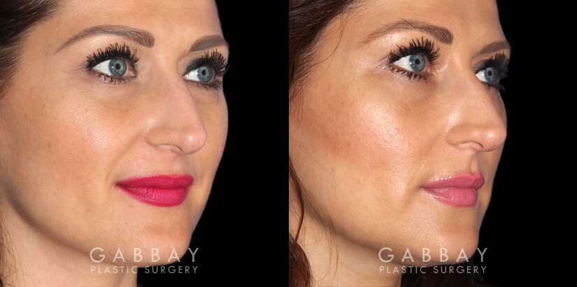 Patient 01 3/4th Right Side View Upper Eyelid Blepharoplasty with Fat Transfer to Face Gabbay Plastic Surgery