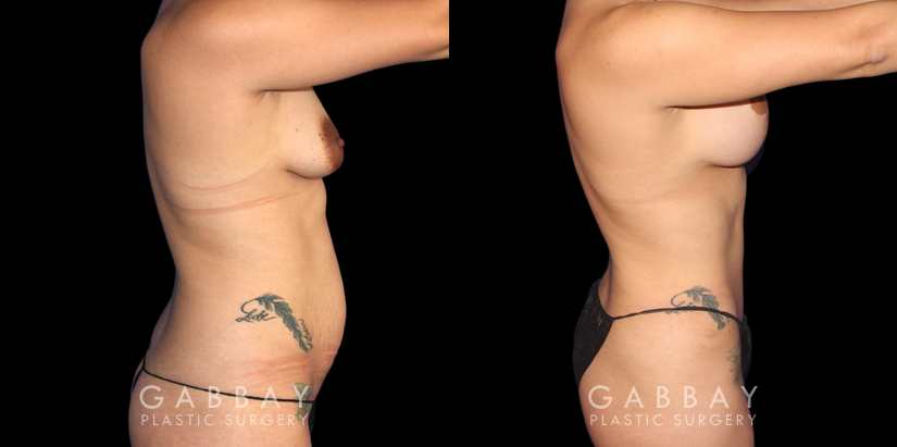 Before and after a mommy makeover consisting of abdominoplasty, breast augmentation, and a breast lift. Using targeted liposuction, created a smoother abdominal contour while also repositioning the breasts with a lift combined with augmentation for improved size and shape.The breast lift also moved the nipples to a higher, symmetrical point. Patient recovery was smooth without complications.