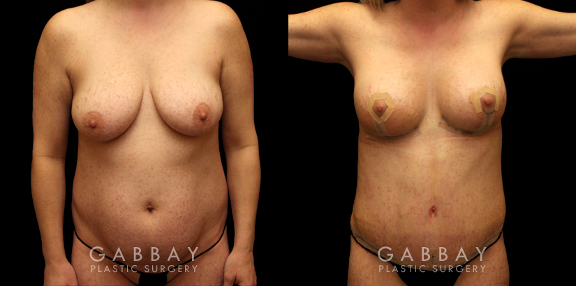 Before and after a mommy makeover consisting of two procedures: tummy tuck and a breast lift. Drooping breasts were repositioned to a higher, firmer aesthetic while targeted abdominal liposuction and tightening restored a prepregnancy contour to the body and silhouette.