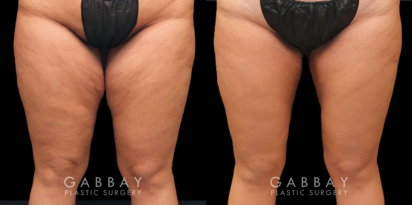 Spiral on sale thigh lift