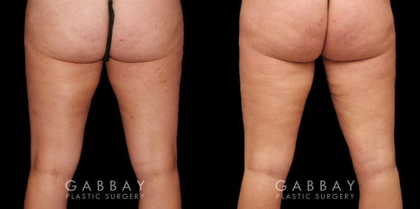 Patient 04 Back View Thigh Lift Gabbay Plastic Surgery