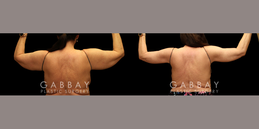 Patient 01 Back View Arm Lift with Lipo Gabbay Plastic Surgery