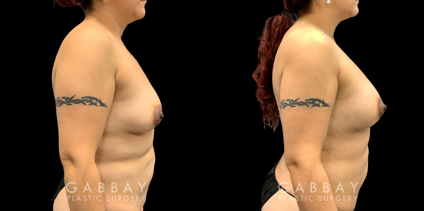 Smartlipo of the Back - Flanks, Bra Rolls, and Neck Humps - Explore Plastic  Surgery