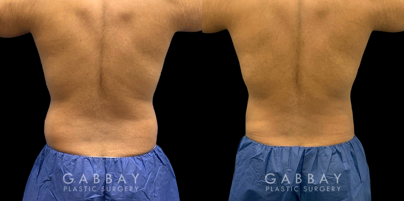 Male patient following 360 liposuction to the abdomen, sides, and back for a more youthful contour while maintaining a masculine feel to the body shape. The result is a tighter overall torso appearance.