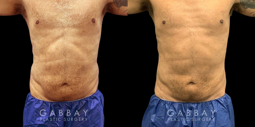 Male liposuction before-and-after photo for 360 lipo showing a result in a slimmer waist and flatter abdominal area for an enhanced torso contour. Flanks are significantly slimmed and present a toned silhouette.