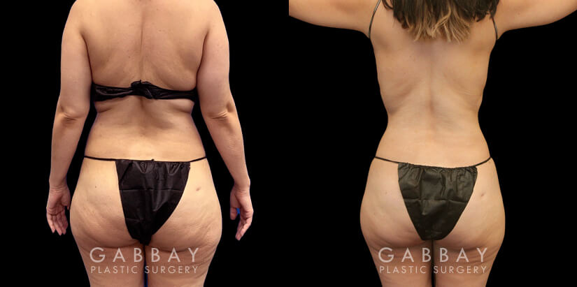 Before and after surgical liposuction for the abdomen, removing stubborn fat with minimal use of invasive techniques. Note the visible belly fat reduction for a smoother contour.