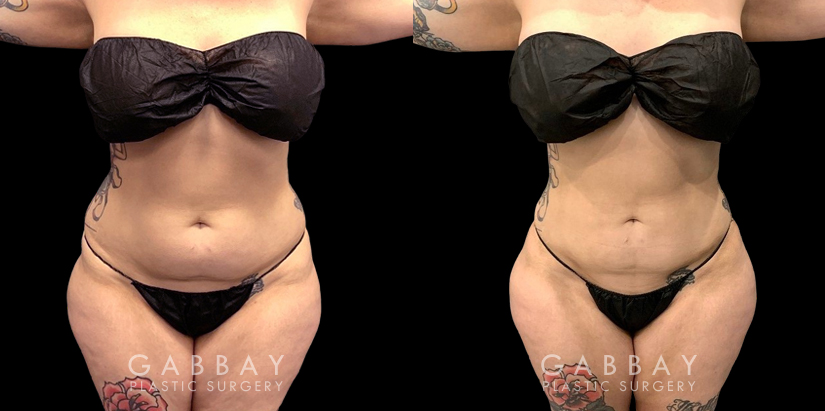 Female liposuction results for a flatter abdomen. Note how fat reduction was done with her natural figure in mind for results that match her unique features.