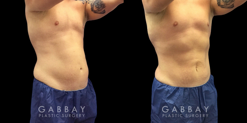 Active male patient wanted to target stubborn belly fat that would not disappear with exercise. Abdominal liposuction allowed him to achieve his target body shape and figure.