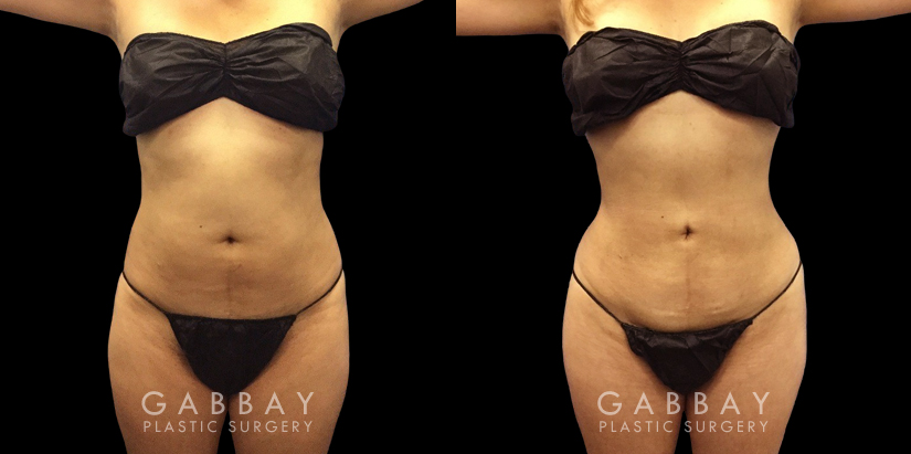 Female patient in her early 40s after abdominal liposuction surgery. Patient’s procedure was straightforward with an uncomplicated recovery period and notable results.