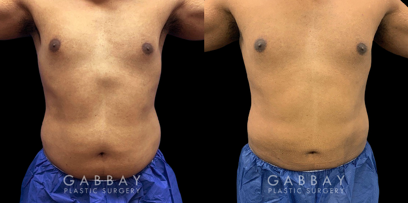 Male patient after surgical removal of abdominal fat. His liposuction results emphasize the naturally masculine form of his torso with a tighter figure overall.