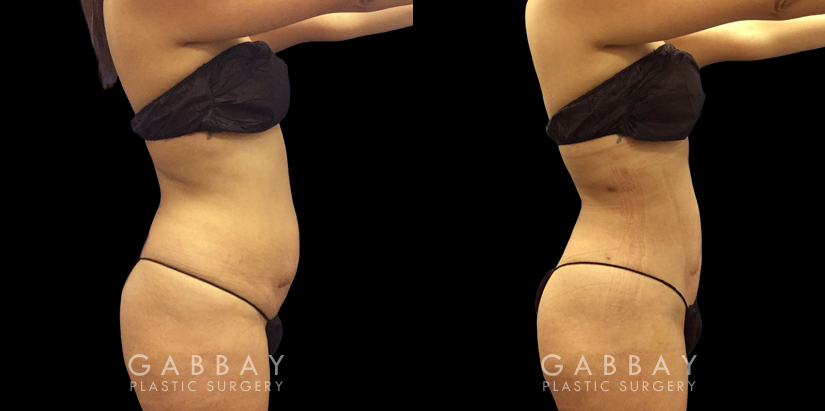 Female patient before and after belly liposuction, enhancing her figure while providing a flatter stomach visible from the side and front. Note the lack of visible scarring.