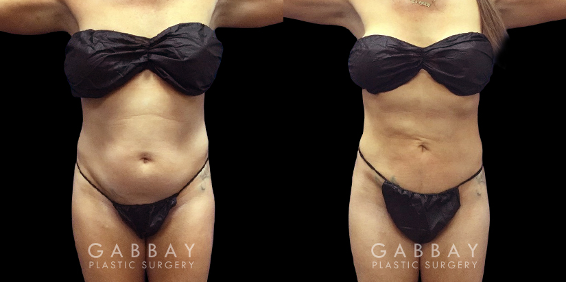 Abdomen Lipo Before and After Photo Gallery, Page 2 of 6