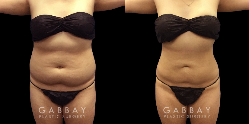 Patient’s surgical belly fat removal results reveal significant slimming after her procedure, with virtually no belly overhang for a flat profile contour.