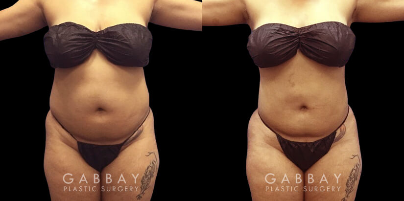 Female patient approaching her target body weight who wanted to remove stubborn fat that was resisting exercise. Abdominal lipo surgery allowed for encouraging slimming of her stomach and waist areas.