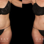 Patient results from tummy tuck. Note before the loose, hanging area at the lower abdomen. Following fat removal and abdominal tightening, the patient achieved a slim, refined silhouette.