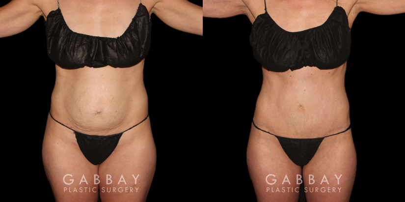 Patient results from tummy tuck. Note before the loose, hanging area at the lower abdomen. Following fat removal and abdominal tightening, the patient achieved a slim, refined silhouette.