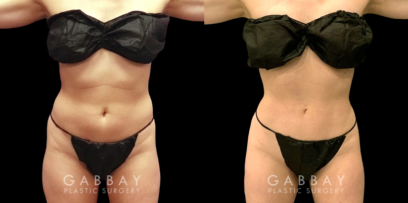 Late 20s female patient with minor stubborn fat wanted to complete her efforts to lose weight. Stomach area liposuction allowed her to achieve a flat abdominal area that looks great from every angle.