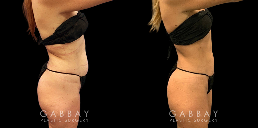 Before-and-after liposuction for the abdomen, showcasing the patient’s flatter stomach. Note how her abdominal muscle contouring is now visible, lending an exceedingly fit aspect to her aesthetic.