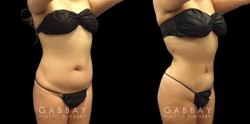 Female patient with enhanced abdominal contours after 360 liposuction surgery. Note the flattened stomach and the dynamic shape to her waist, restoring her natural curves.