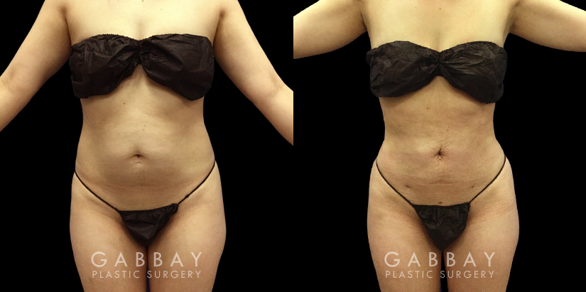 Before-and-after photo for 360 and abdominal liposuction combination. Note the emphasized contour of the waist, which in turn emphasizes the roundness of the buttocks.