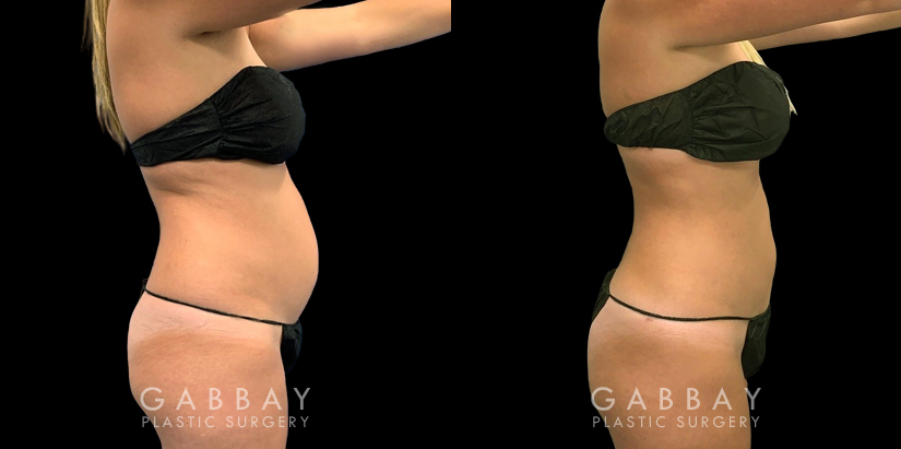 Patient after mild liposuction, demonstrating a significantly flatter stomach area from the profile angle. Patient’s recovery was without complications, and lead to virtually no visible scarring.