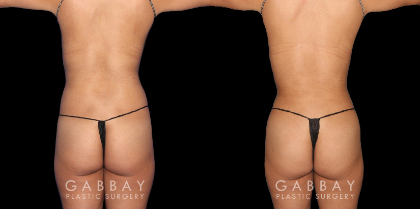 Before-and-after for patient with combined cosmetic surgeries, including BBL, abdominal lipo. Note the 360-degree slimming with enhanced buttocks roundness from the natural fat transfer.