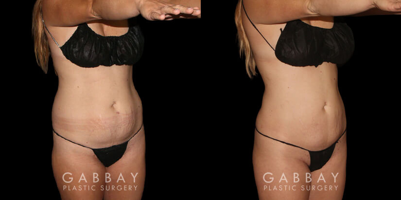 Results for a patient with 360 liposuction for abdomen, waist, and tailbone for a BBL fat transfer surgery. Note the flattened stomach and enhanced shape of the buttocks for a more impressive figure overall.