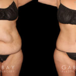 Note the significant tightening of the loose pockets of skin and stubborn fat around the abdomen following weight loss. After her tummy tuck, this patient saw a flattened stomach and enjoyed the benefits of her effort to lose weight.