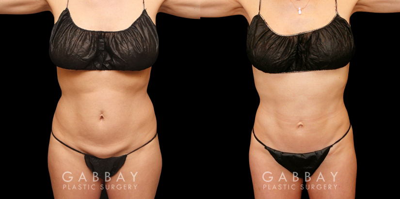 Patient with combined abdominal liposuction with liposuction targeting stubborn fat bulges on her back. The combined procedure restored a youthful figure and slimmed contours.